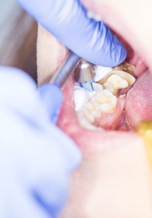 Dental Implants in Calamba